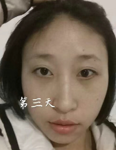 去眼袋手术