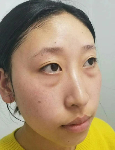 去眼袋手术