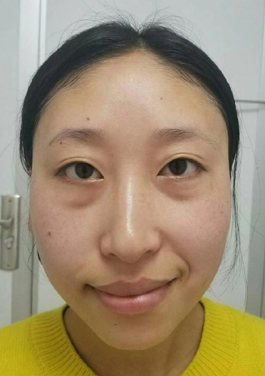 去眼袋手术