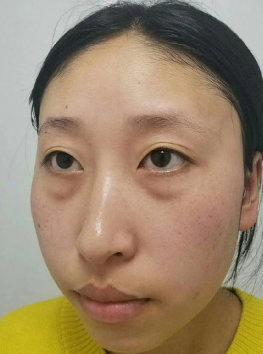 去眼袋手术