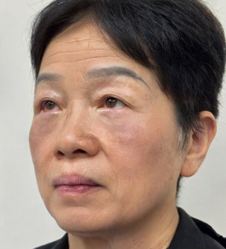 去眼袋手术
