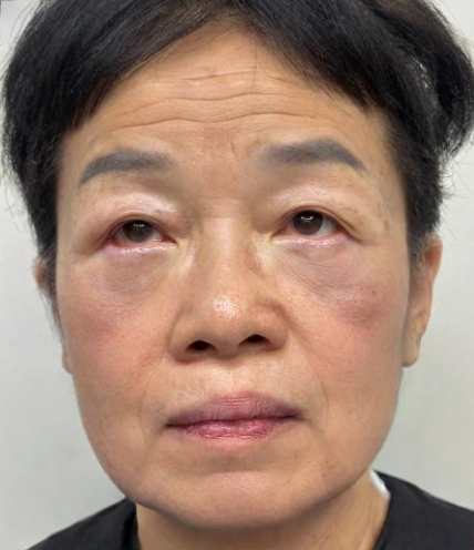 去眼袋手术