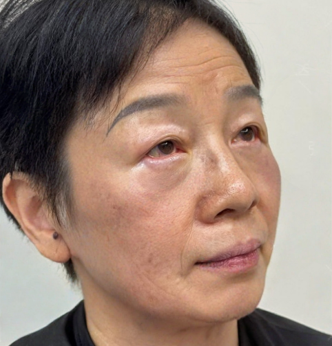 去眼袋手术