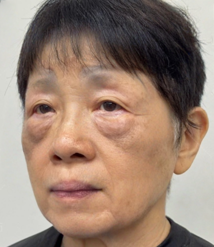 去眼袋手术