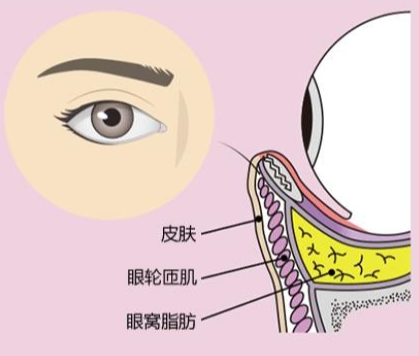 去眼袋手术