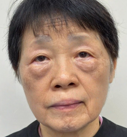 去眼袋手术