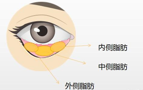 去眼袋手术