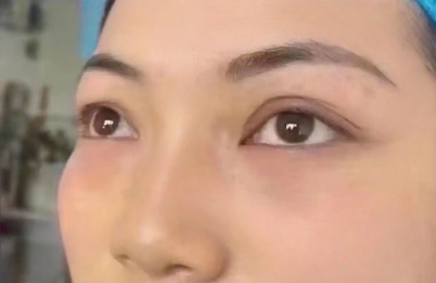 去眼袋手术