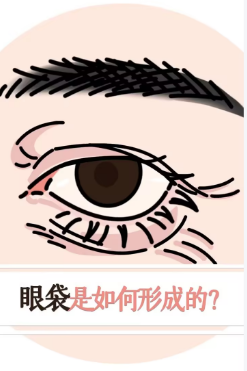 去眼袋手术