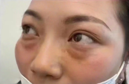 去眼袋手术