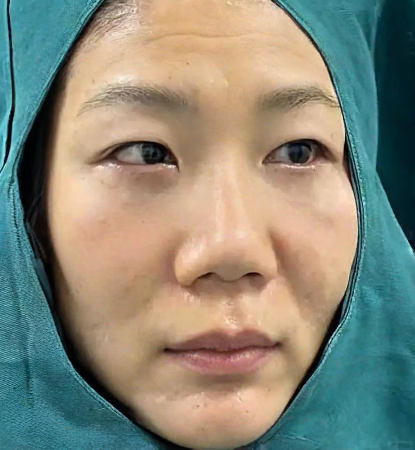 去眼袋手术