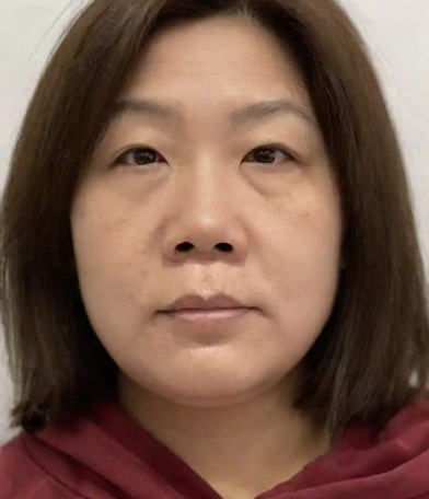 去眼袋手术