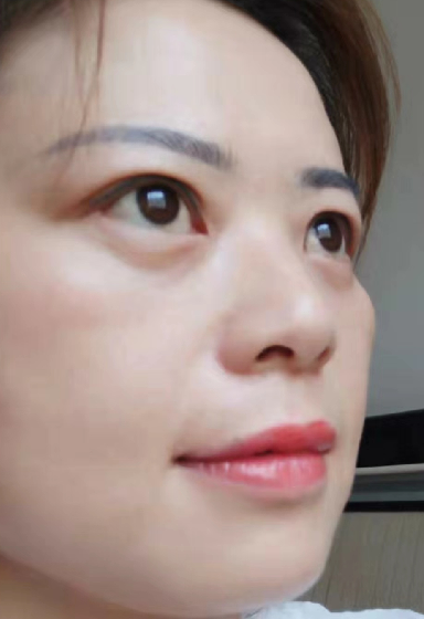 去眼袋手术