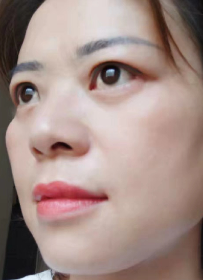 去眼袋手术