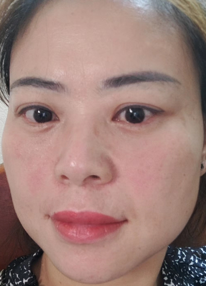 去眼袋手术