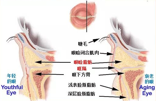 去眼袋手术
