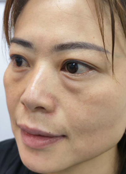 去眼袋手术