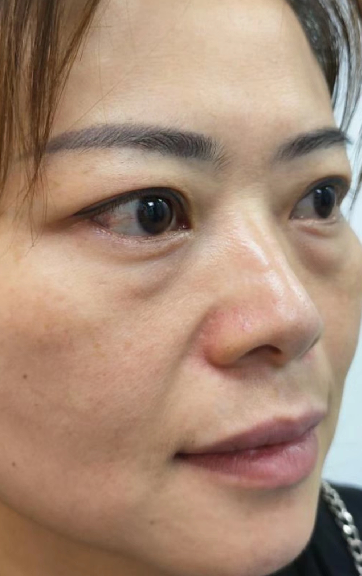 去眼袋手术