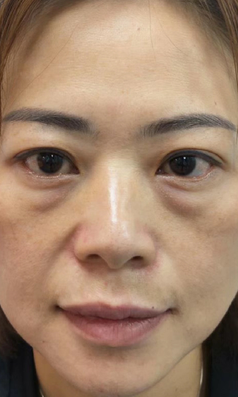 去眼袋手术