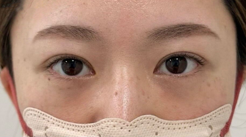 去眼袋手术