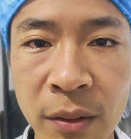 去眼袋手术