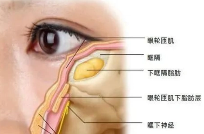 去眼袋手术