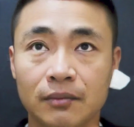 去眼袋手术