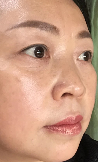 去眼袋手术