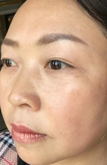 去眼袋手术