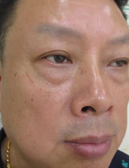 去眼袋手术
