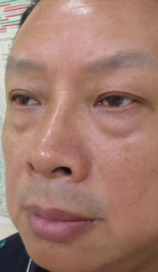 去眼袋手术