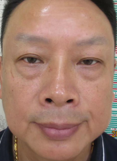 去眼袋手术