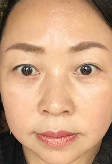 去眼袋手术