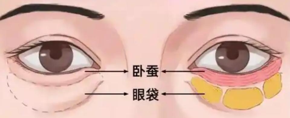 去眼袋手术