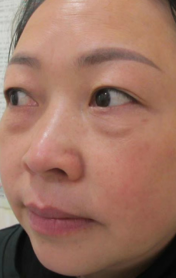 去眼袋手术
