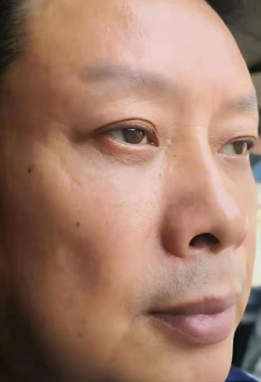 去眼袋手术