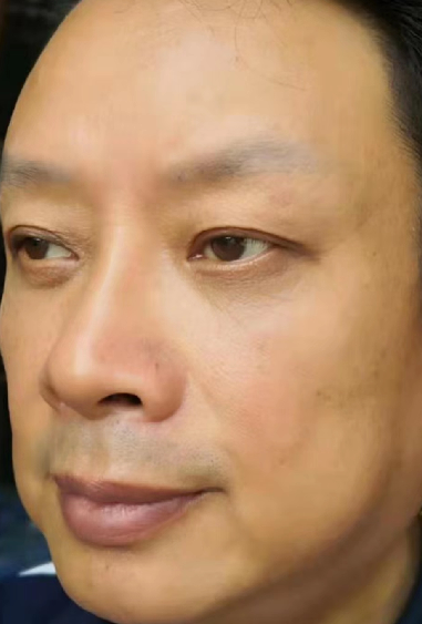 去眼袋手术