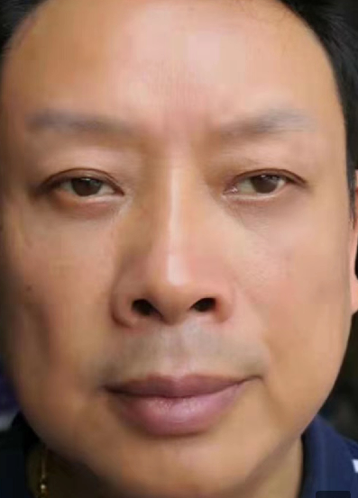 去眼袋手术