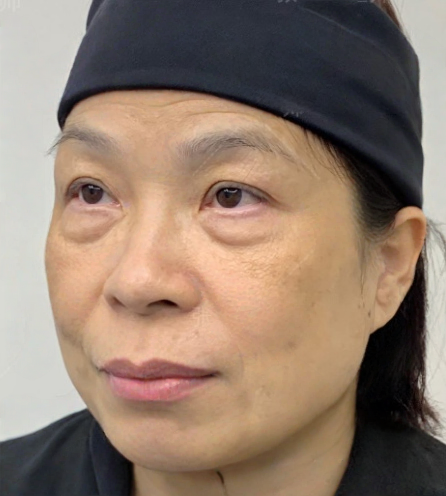 去眼袋手术