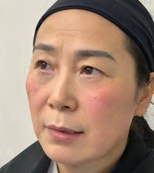 去眼袋手术