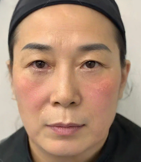 去眼袋手术