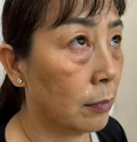 去眼袋手术