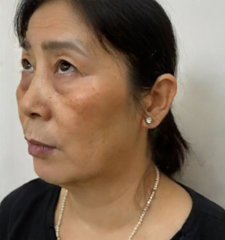 去眼袋手术