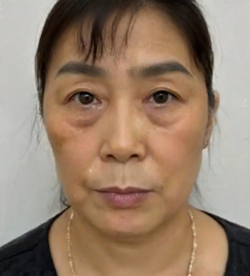 去眼袋手术