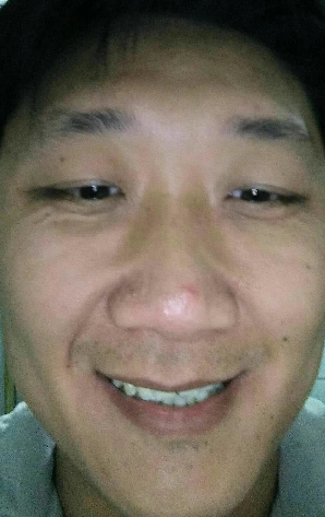 去眼袋手术