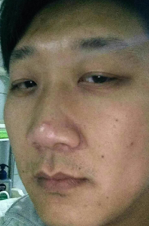 去眼袋手术