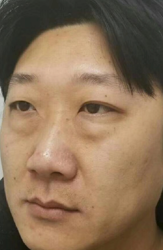 去眼袋手术