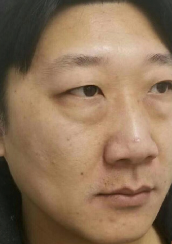去眼袋手术