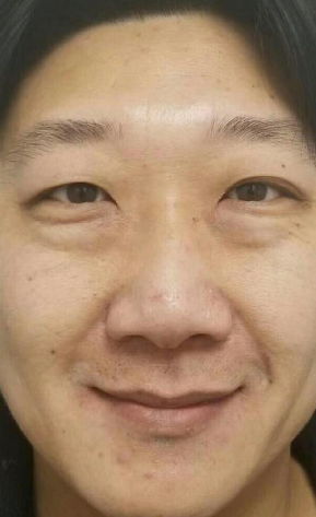 去眼袋手术