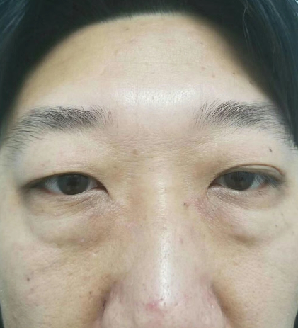 去眼袋手术
